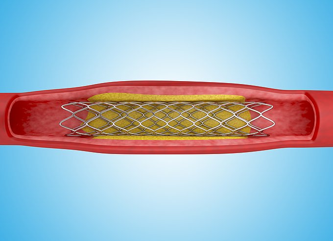 Dies ist eine illustrative Darstellung eines Stents.