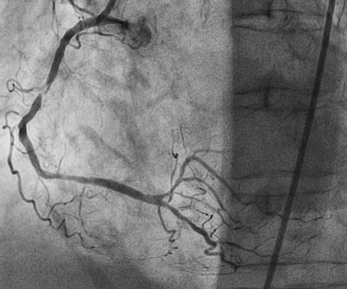 Dies ist eine Angiografie von einem verengtem Herzkranzgefäß.