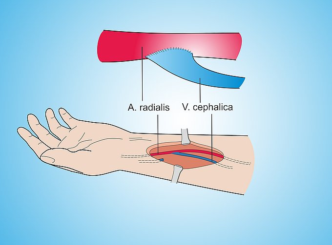 Dies zeigt illustrativ den Einsatz von Dialyse Shunts am Unterarm.