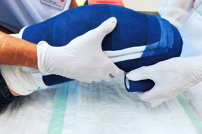 Dies stellt dar, wie ein Stumpfcast an einem amputierten Unterschenkel angelegt wird.